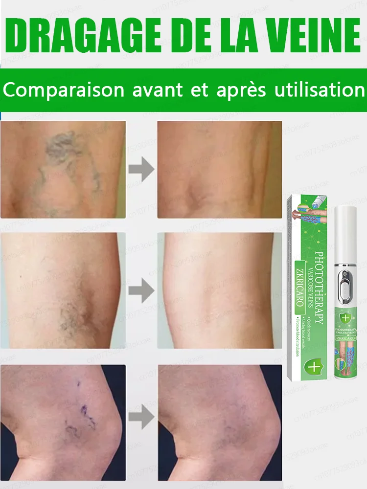 laser,Débarrassez-vous des varices