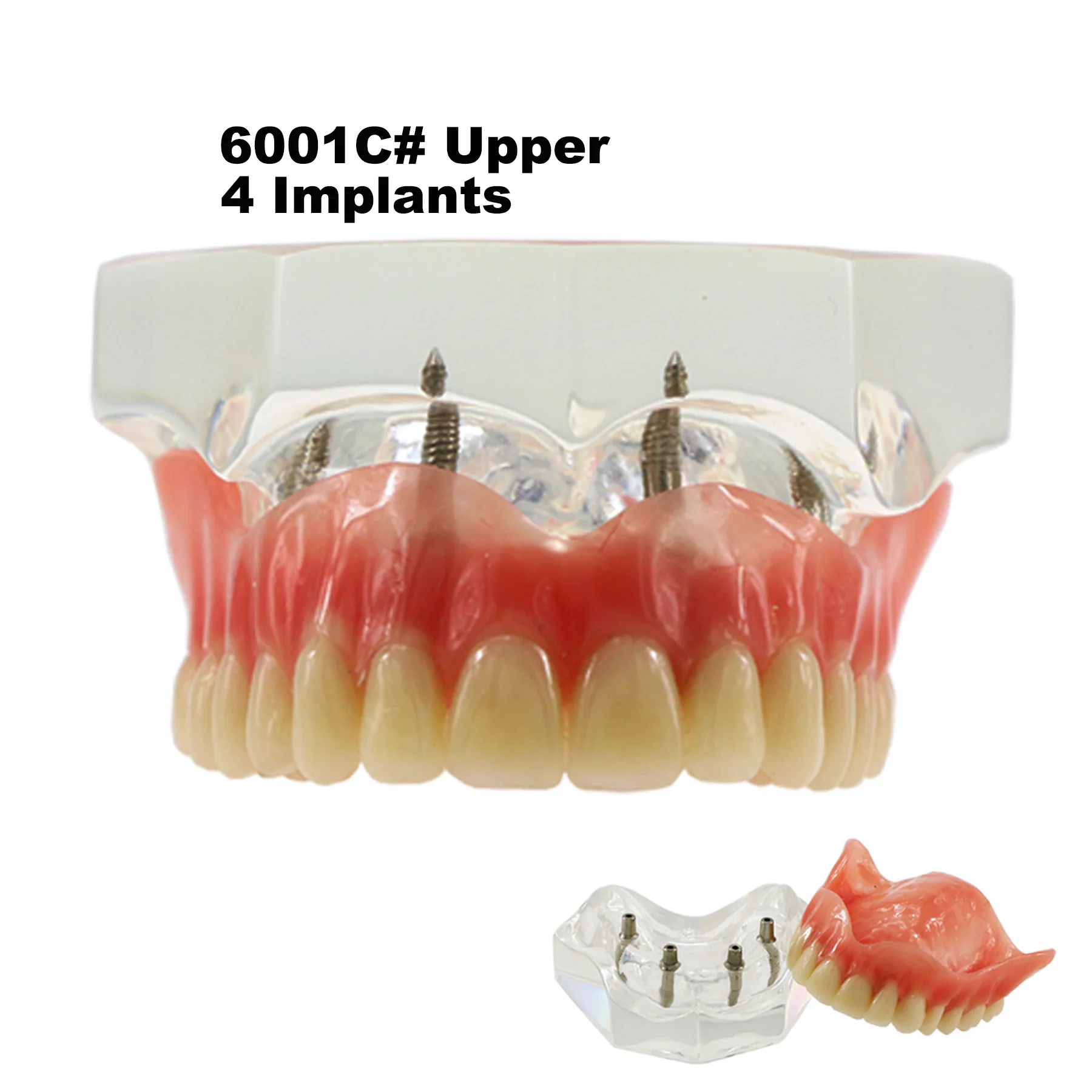 Dental Implant Typodont Teeth Model Overdenture 2 4 Implants Superior Upper Lower Inferior Restoration Demo For Teach Study