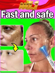 laser spots whitening