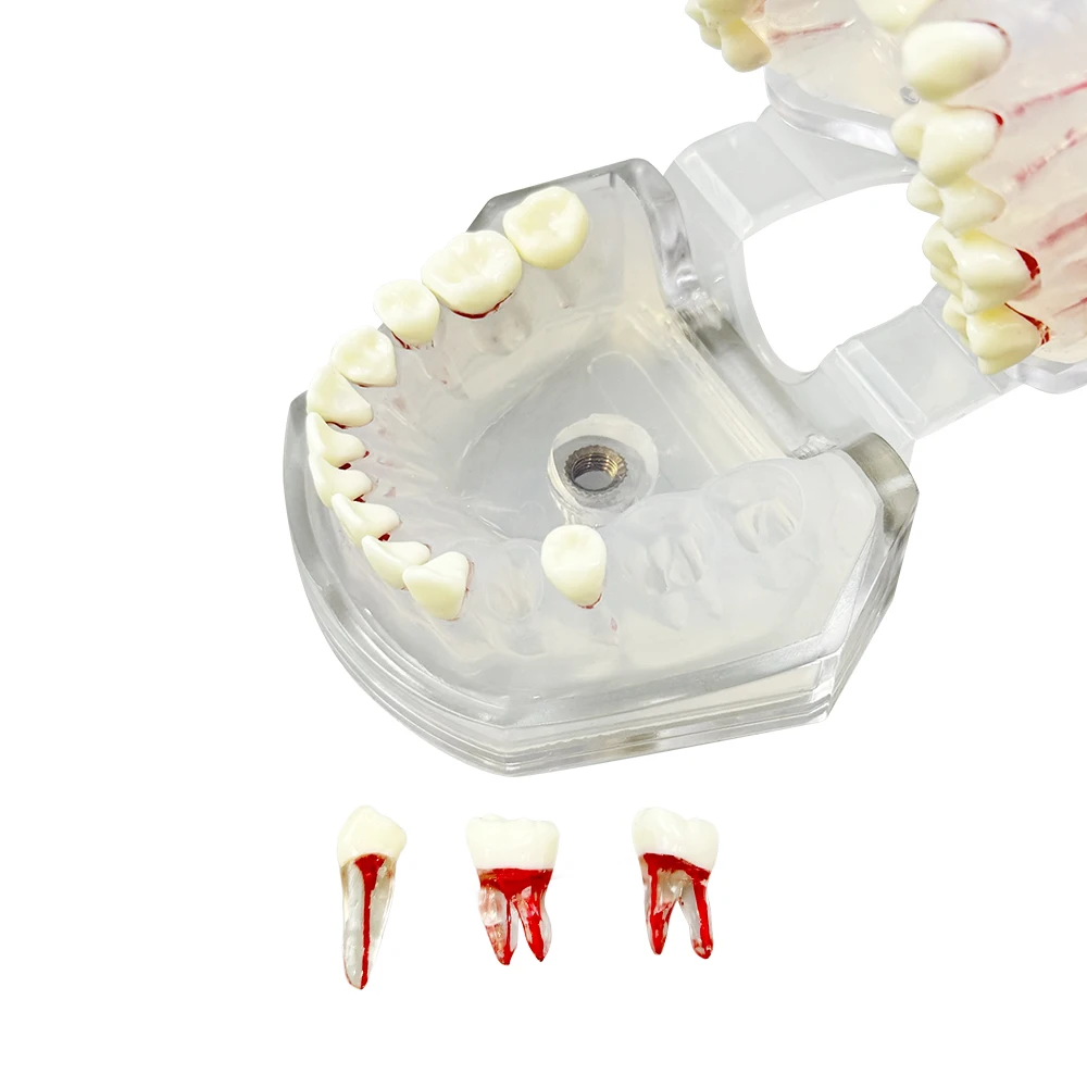 Teeth Teaching Model Removable with Endodontic Root Canal Soft Gum Dental ModelFor Dentistry Practice Training Studying Typodont