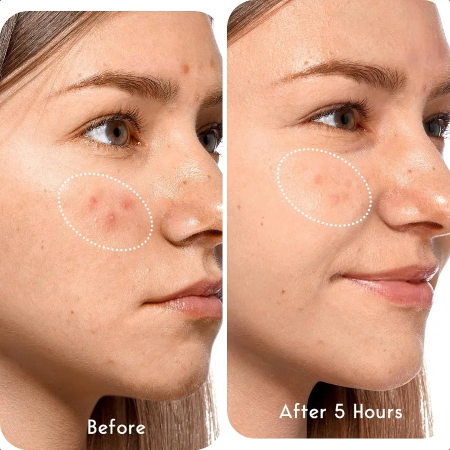 بقع حب الشباب بقع كبيرة الغروانية المائية لبراعم Zit وعيوب حب الشباب للوجه والذقن والظهر والجسم مع الشاي #6