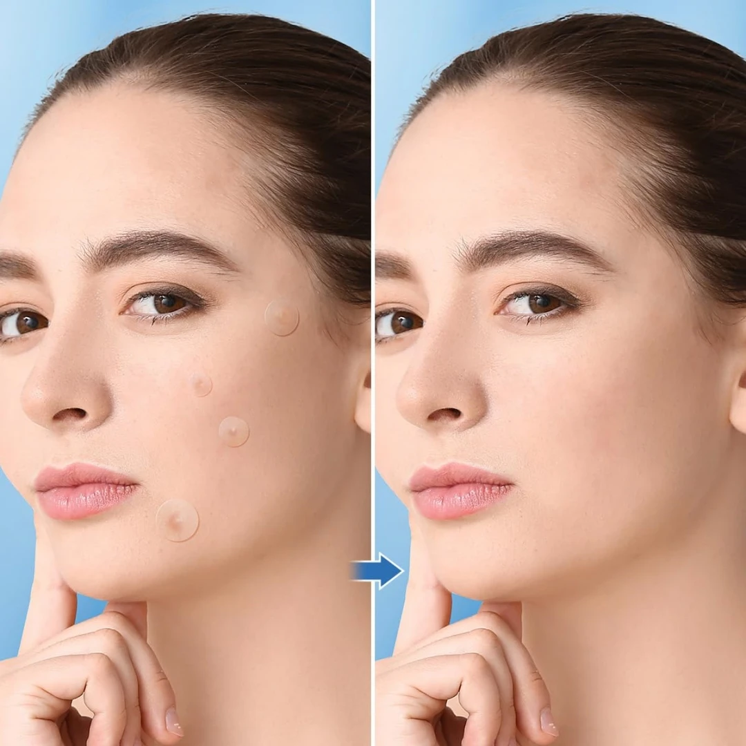 Invisible Acne Patches 400/800 Pieces Conceal Pimples Blemishes Suitable for All Skin Types Disappears into Skin