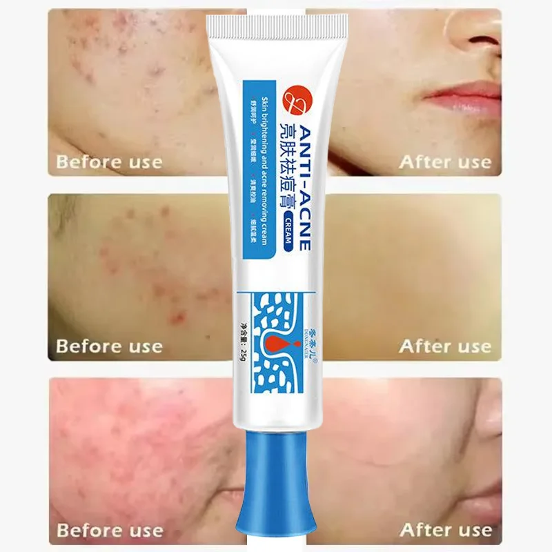 20g Anti-Acne Cream Salicylic Acid Deep Cleaning Pore Repair Pimple Spots Shrinking Oil Control Whitening Moisturizer Skin Care