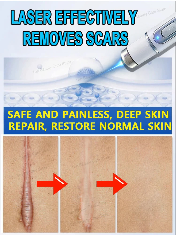 Scar laser products 𝑄𝑢𝑖𝑐𝑘 𝑠𝑐𝑎𝑟 𝑟𝑒𝑚𝑜𝑣𝑎𝑙