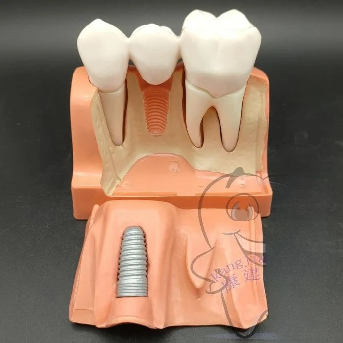 Lab 4Ximplant Interpretation Model, Denture Restoration, Removable Lab Implants, Bridge Crowns, Implant Model Tool