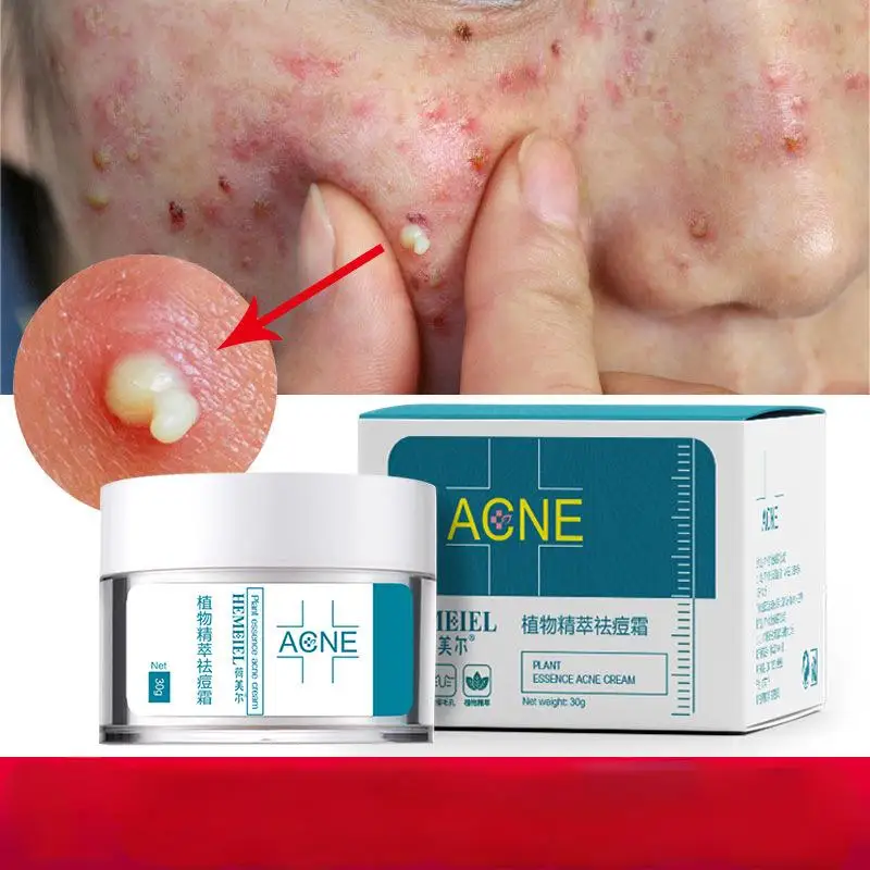 Acne removing cream regulates acne muscles, removes acne, desalinates acne marks, moisturizes and repairs face cream acne