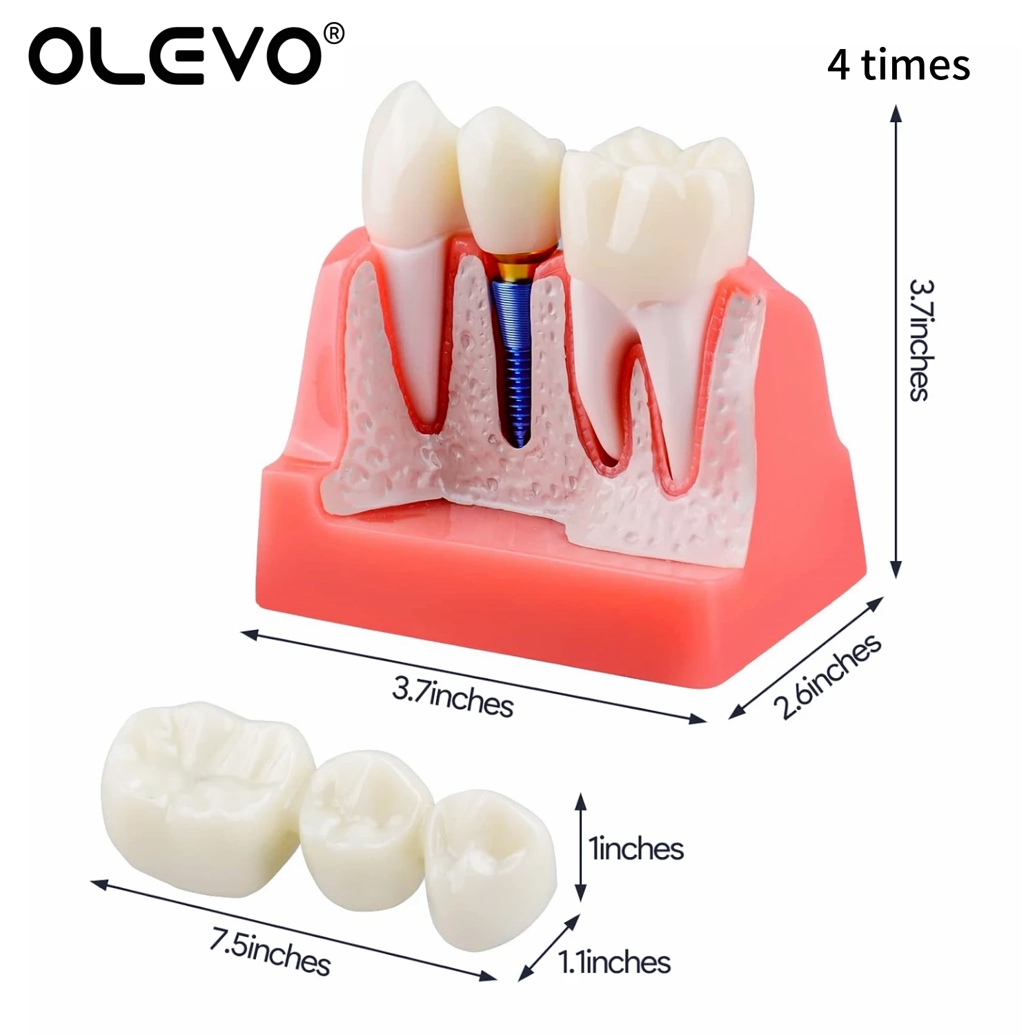 Dental Teeth Model Anatomy Teaching Model 6 Times Caries Comparison 4 Times Implant Analysis Crown Bridge Demonstration Model