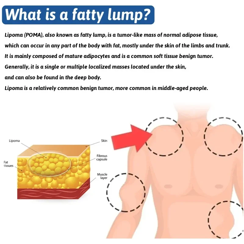 Pomada de eliminación de Lipoma, tratamiento de celulitis, eliminador de Fibroma, bultos subcutáneos, múltiples Lipomas, masa de grasa, crema de medicamentos, 20G