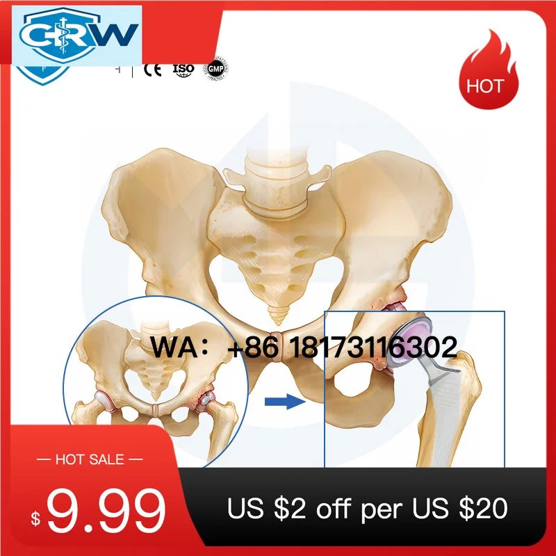 CRW Bipolar AK-MP-TP Femoral Stem   Joint Prosthesis Rotational Stability Plasma-Spray Coating   Interventional Materia