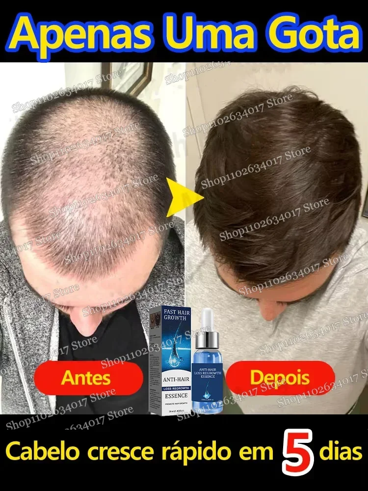 Nutre y cuidado del cabello masculino y femenino Tratamiento reparador con crecimiento del cabello Tratamiento de alopecia seborreica para adelgazar el cabello