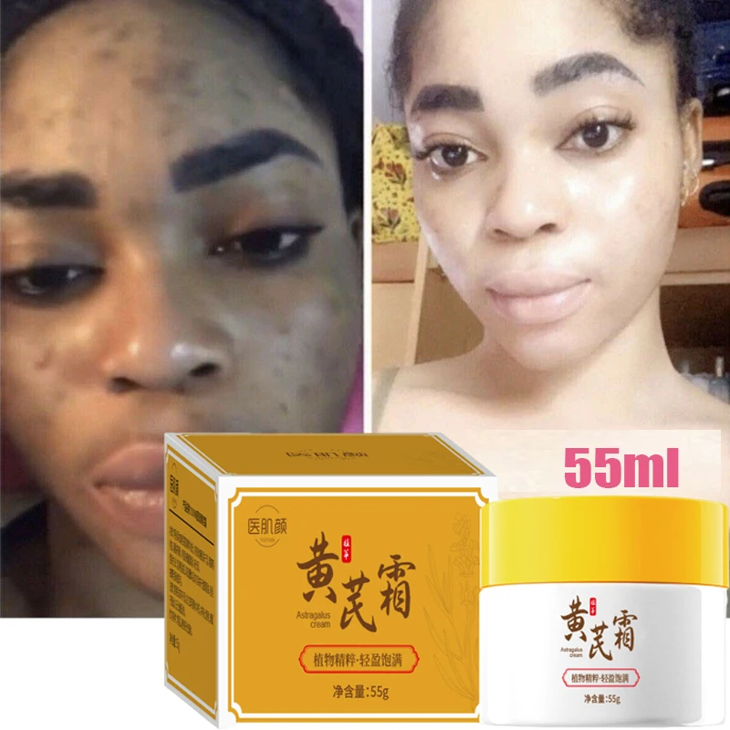 

Whitening Freckles Face Cream Removal Melasma Dark Spots Corrector Lighten Melanin Pigmentation Brighten Anti-Aging Beauty Care