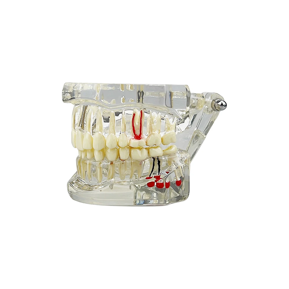 Removable Transparent Disease Teeth Model Teeth Restoration Model for Dentist Student Practice Training Oral Medical Models