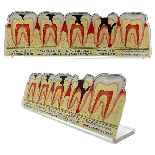 Imagen 2 del producto Modelo Dental, modelo de diente de enfermedad, modelo de caries dentales, modelo de enseñanza, modelos de comunicación de médico-patiento, regalo de dentista, odontología
