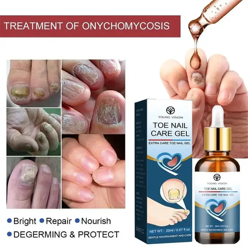 Nail Fungus Treatment Serum Foot Repair Liquid Toe Nails Fungal Removal Gel Anti Infection Paronychia Onychomycosis Cream 20ml