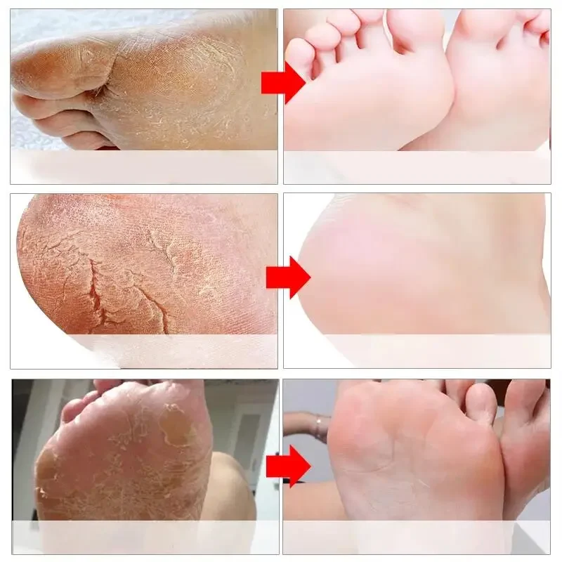 Creme Anti-Crack Hand Foot, Salto Anti-Secagem, Reparação rachada, Remoção de máscara de pés, Pele morta, Hidratante, Branqueamento dos pés