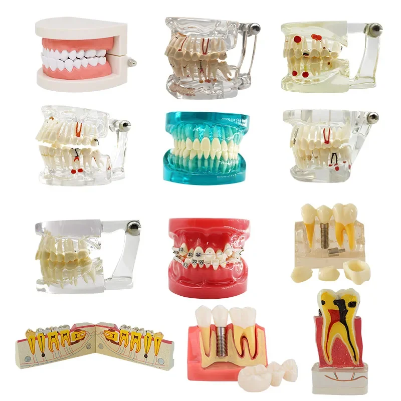 

Dentals Model Teeth Implants Restorations Bridges Teachings Study Tooth Medicals Sciences Diseases Dentists Dentistrys Products