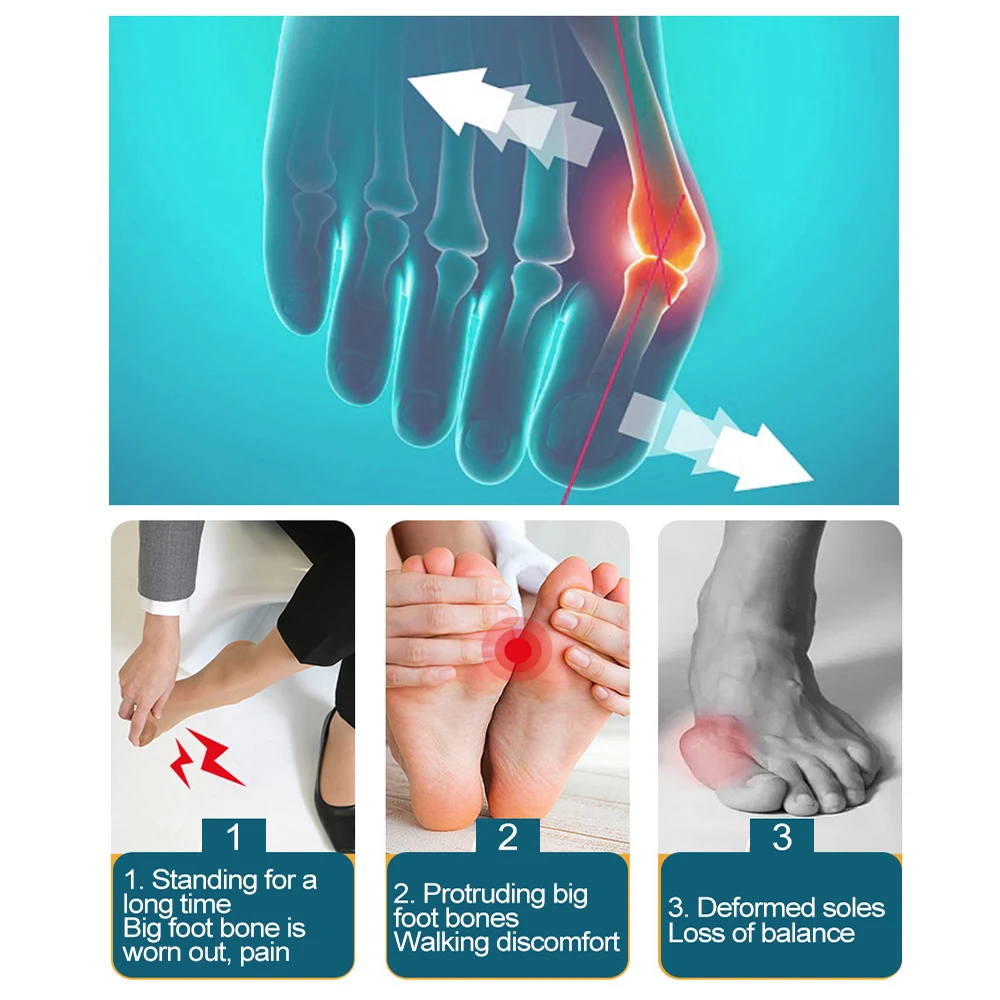 2 قطعة كبير العظام تو جبيرة ورم مستقيم مصحح القدم باديكير جورب ل أروح قدم الرعاية حامي أدوات العناية بالقدم #4