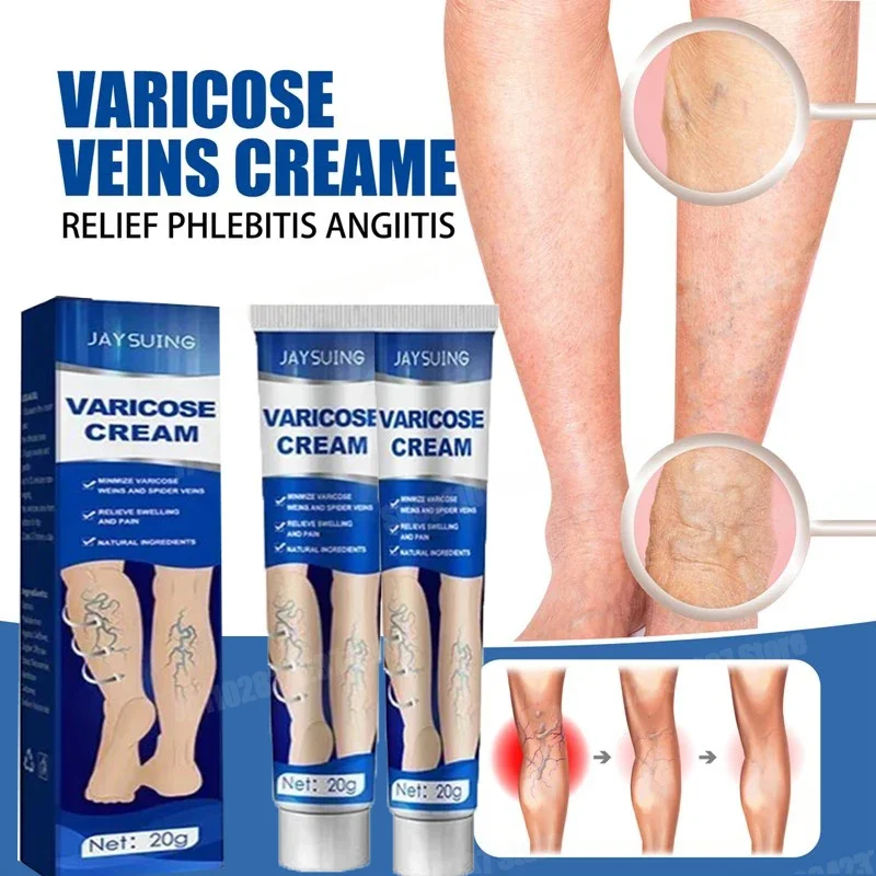 Varicose veins effectively alleviate lower limb vasculitis and improve circulation in patients with venous inflammation