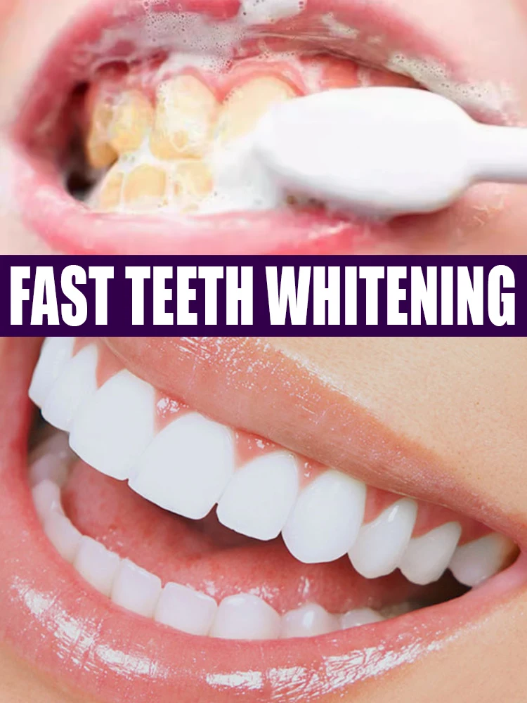 Teeth whitening mousse, preventing tooth decay, removing yellow teeth, and refreshing the mouth