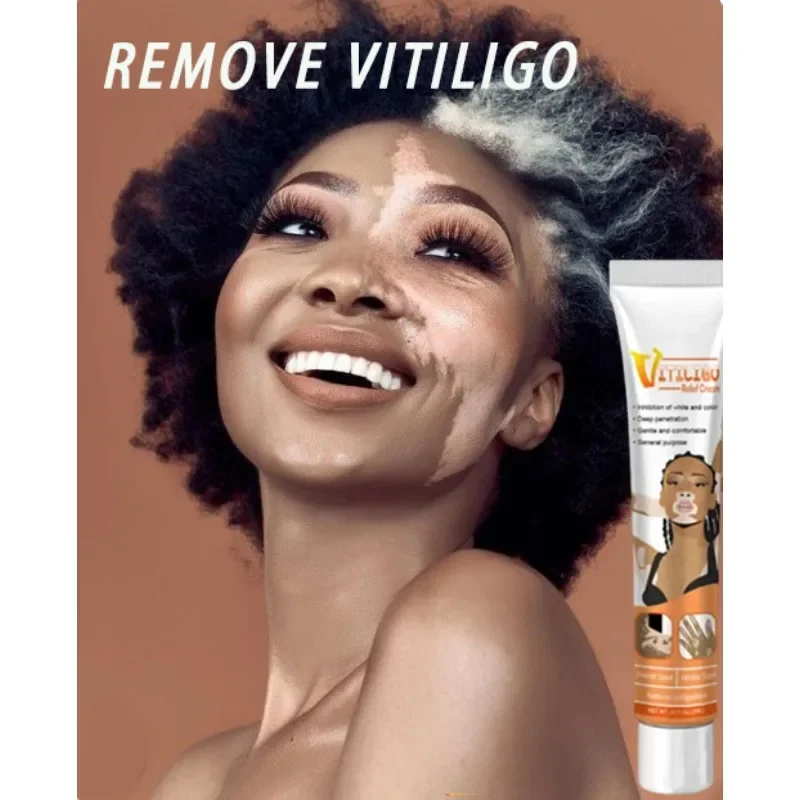 

Vitiligo Cream Effectively Remove White Spot Removal Skin Vitiligo Eliminate Vitiligo Body Skin Care