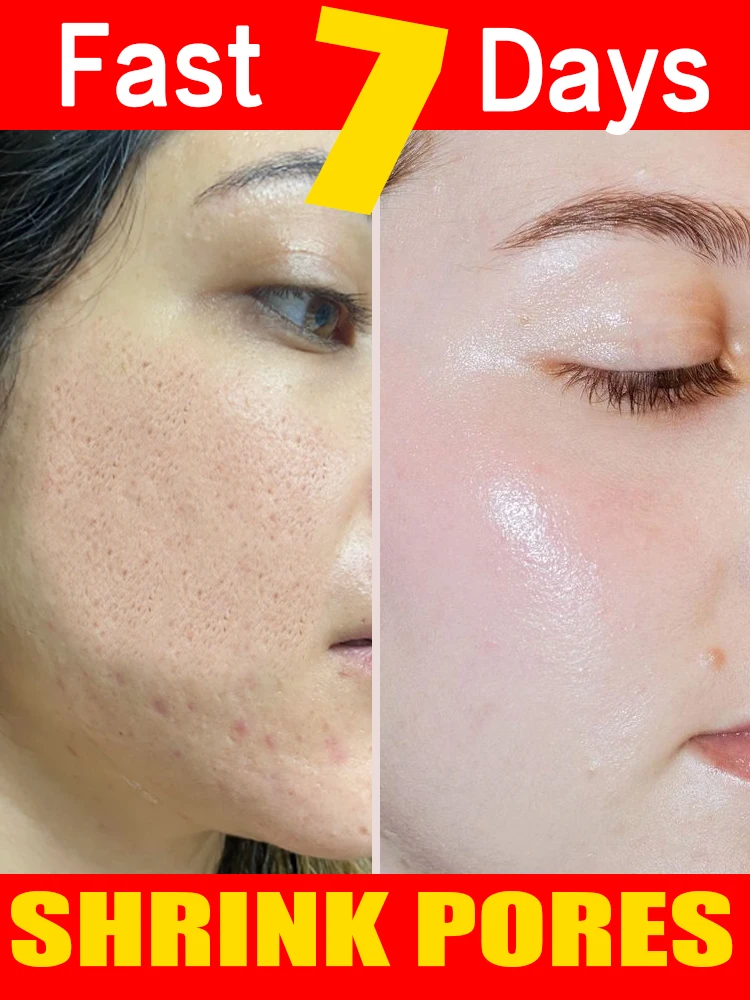 Shrinking pores, oil removing blackheads, skin whitening, and effective shrinkage