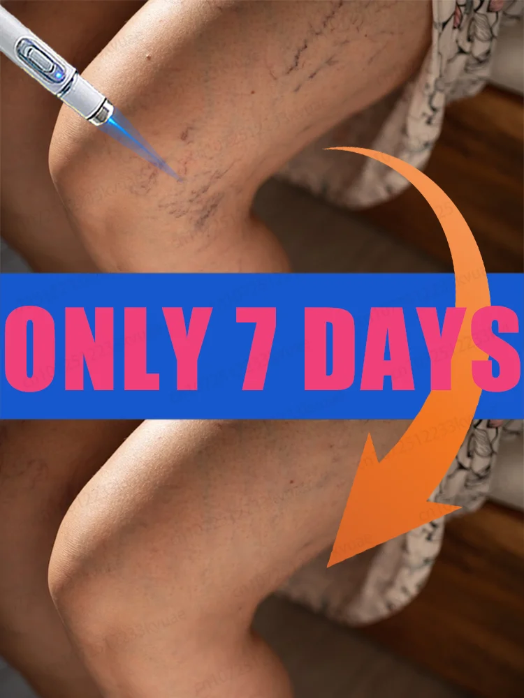 

Laser treatment for varicose veins,ᴍᴇᴅɪᴄᴀʟ grade equipment, painless treatment for spider veins and blood in the legs