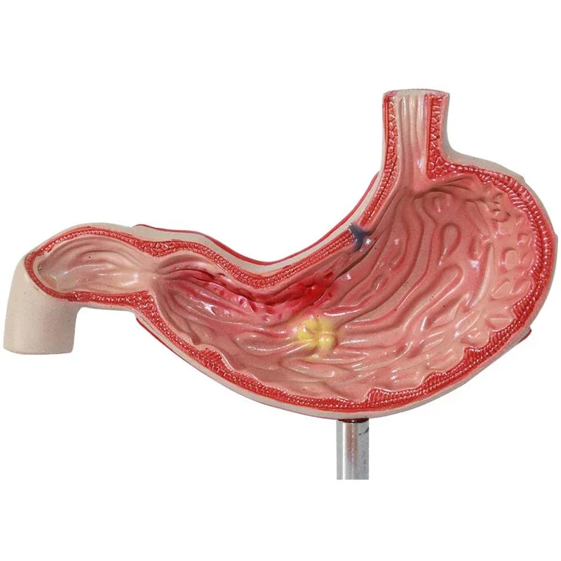 Human Anatomy Anatomy Stomach Medical Model Stomach Pathology Gastritis Ulcer Anatomy Medical Teaching Tool