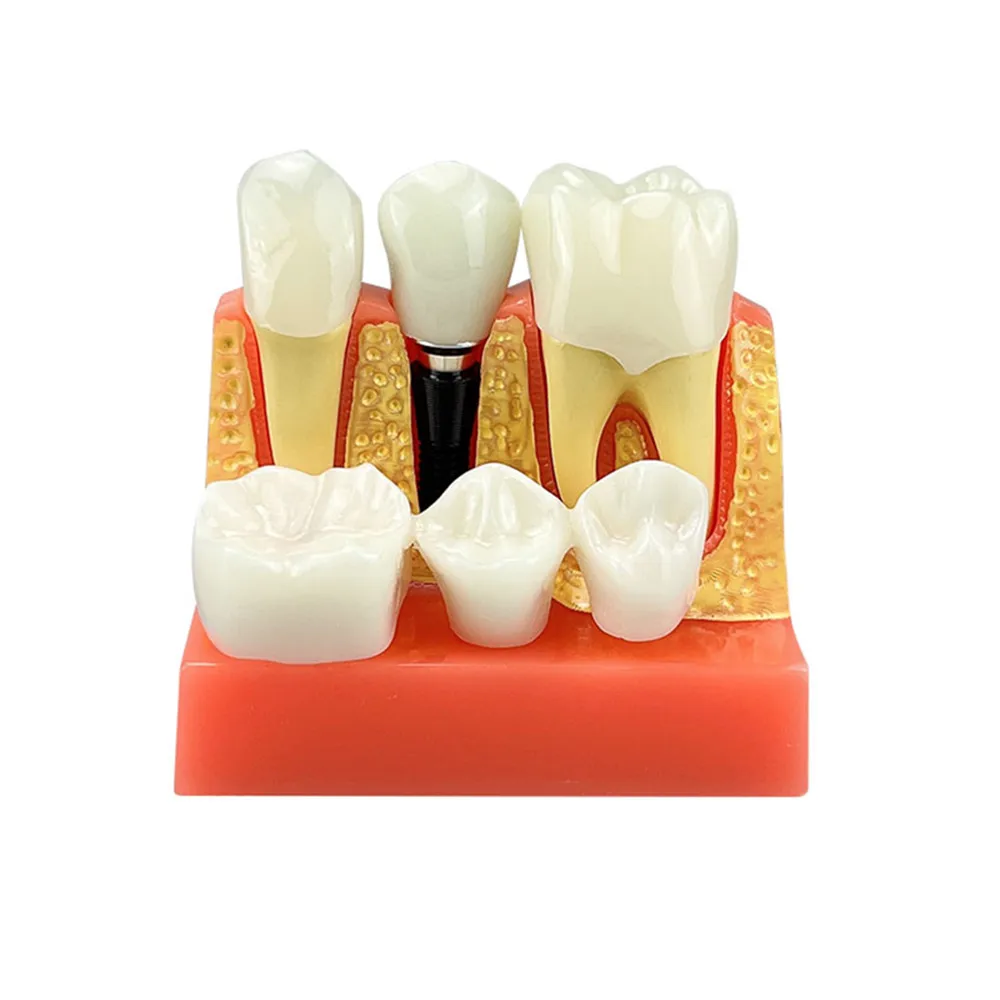 Dental Training Model 4 Times Teeth Implant Analysis Crown Bridge Removable Model For Dentistry Medical Science Teaching Study