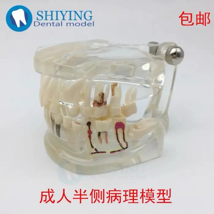 Dental Oral Teaching Model Caries Development Demonstration Crystal Adult Pathological Model Dental Anatomy Display