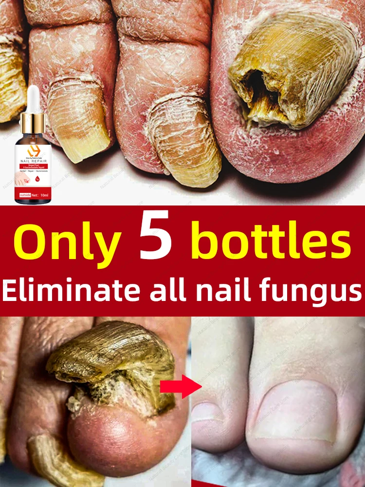 Fungus Nails Fungal Nail Repair Fast