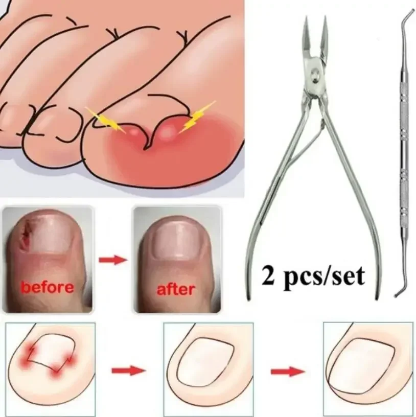 Wrastające paznokcie stóp Pedicure narzędzie do pielęgnacji stóp obcinacz do korekcji paznokci do ortezy martwa skóra do usuwania podiatrii