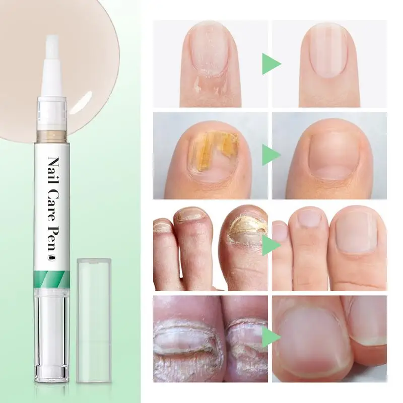 เล็บโภชนาการน้ํามันปากกาวิตามิน Cuticle Revitalizer น้ํามันเล็บ Edge Barbs Cuticle Revitalizer ปากกาเล็บ Cuticle Oil ปากกา