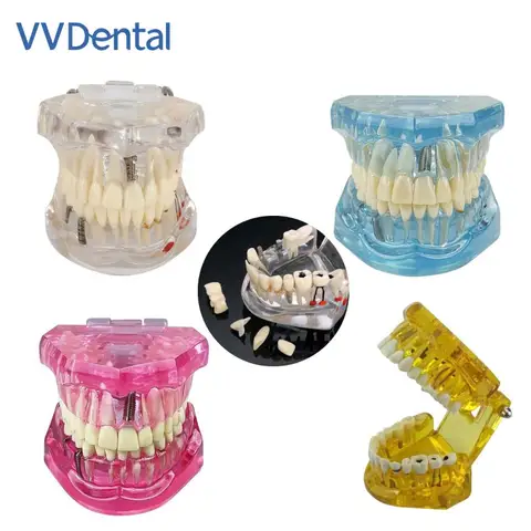 VV Dental 4 Colors Oral Care Teaching Demonstration Model For Studying Dentistry Products Analysis  Removable Teeth Model