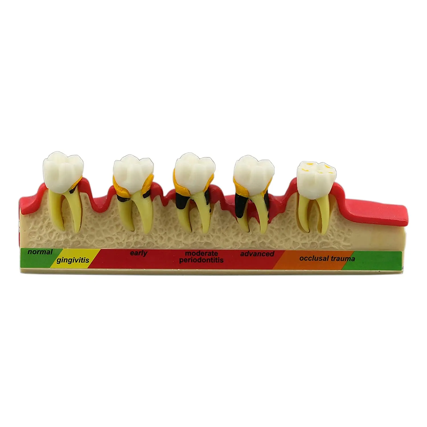 Dental Teeth Model TYPE-40 M4010 Typodont Ortho Implant Pathological Perio Practice