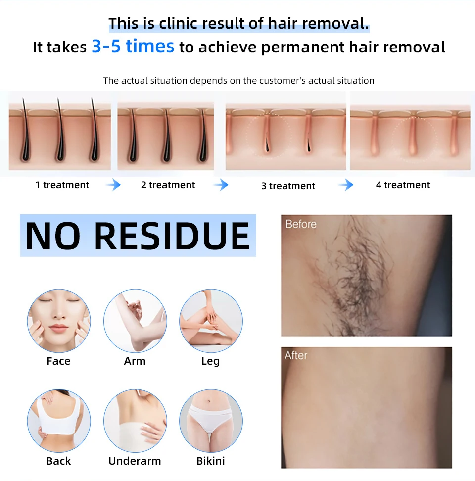 808nm 전문 미니 다이오드 레이저 제모기 빠른 플래시 제모기 무통 영구 제모기 전신 치료 여성