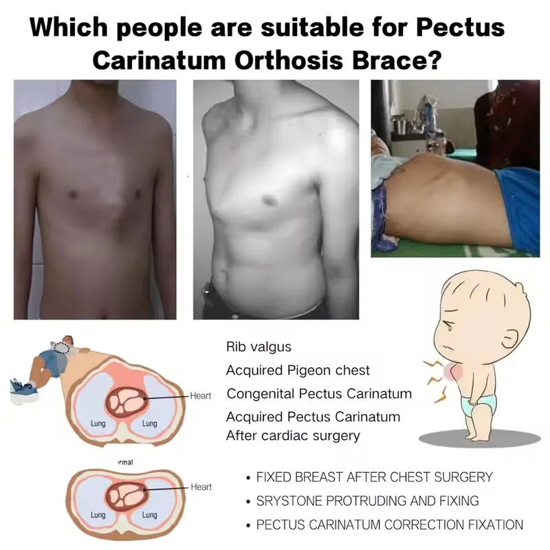 

Adjuster Pectus Carinatum Orthosis Brace, Adjustable Pigeon Chest Orthosis Support, Ribs Valgus Orthosis Braces