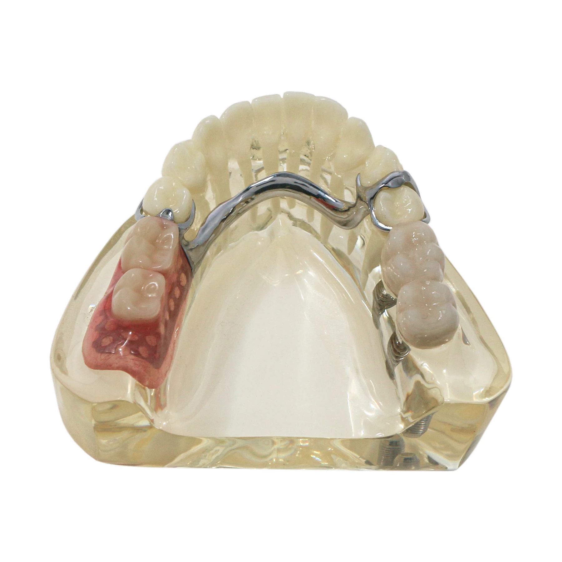 Dental Implant Restoration Typodont Teeth Model with Partial Denture M6022