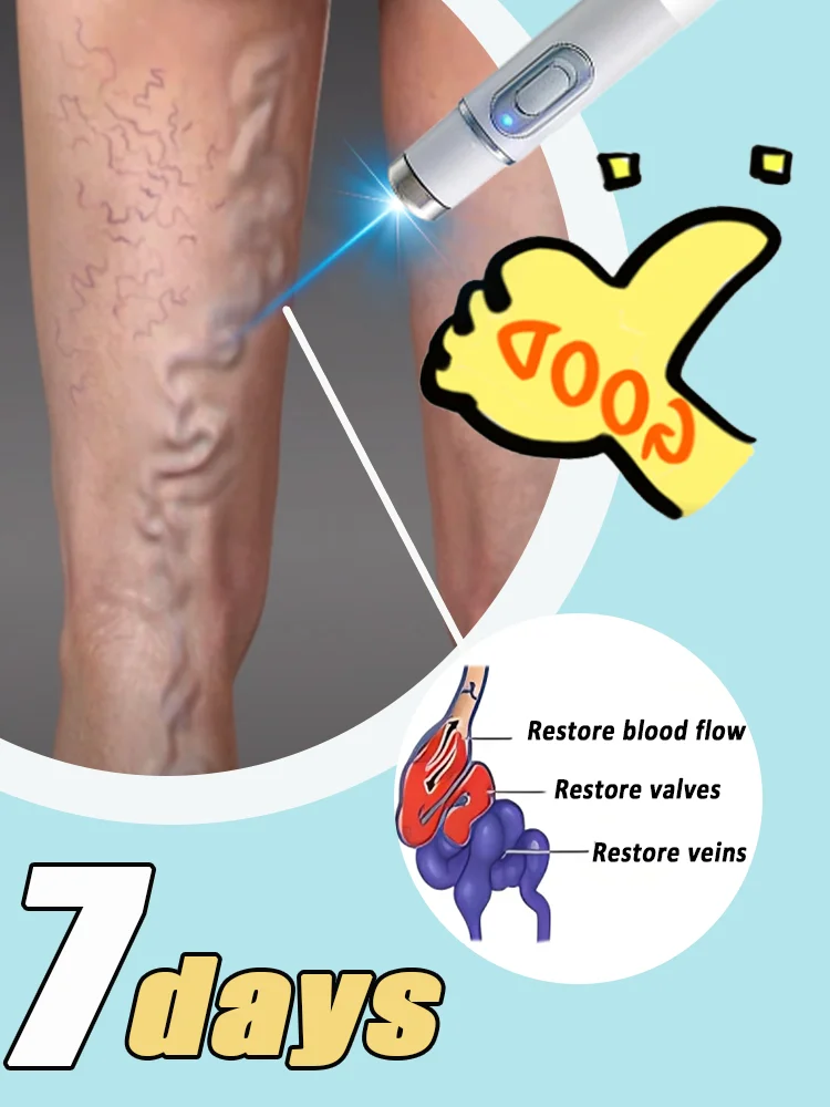 

Ручка с синим светом решает варикозное расширение вен, НОВЫЕ горячие продажи инструментов для ухода за ногами 2025 года