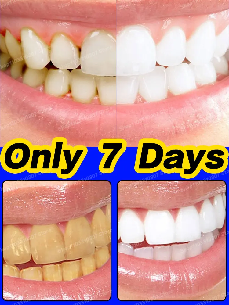 

Teeth Whitening Foam Dental Plaque Calculus