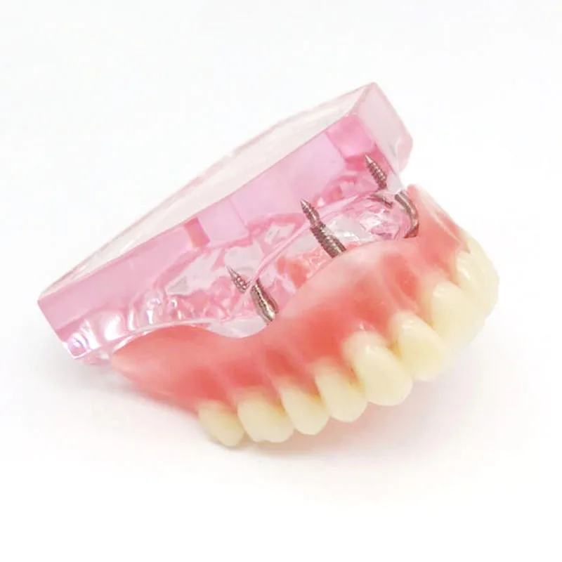 Dental Oral Teaching Denture Implant and Restoration Model Upper Half Mouth