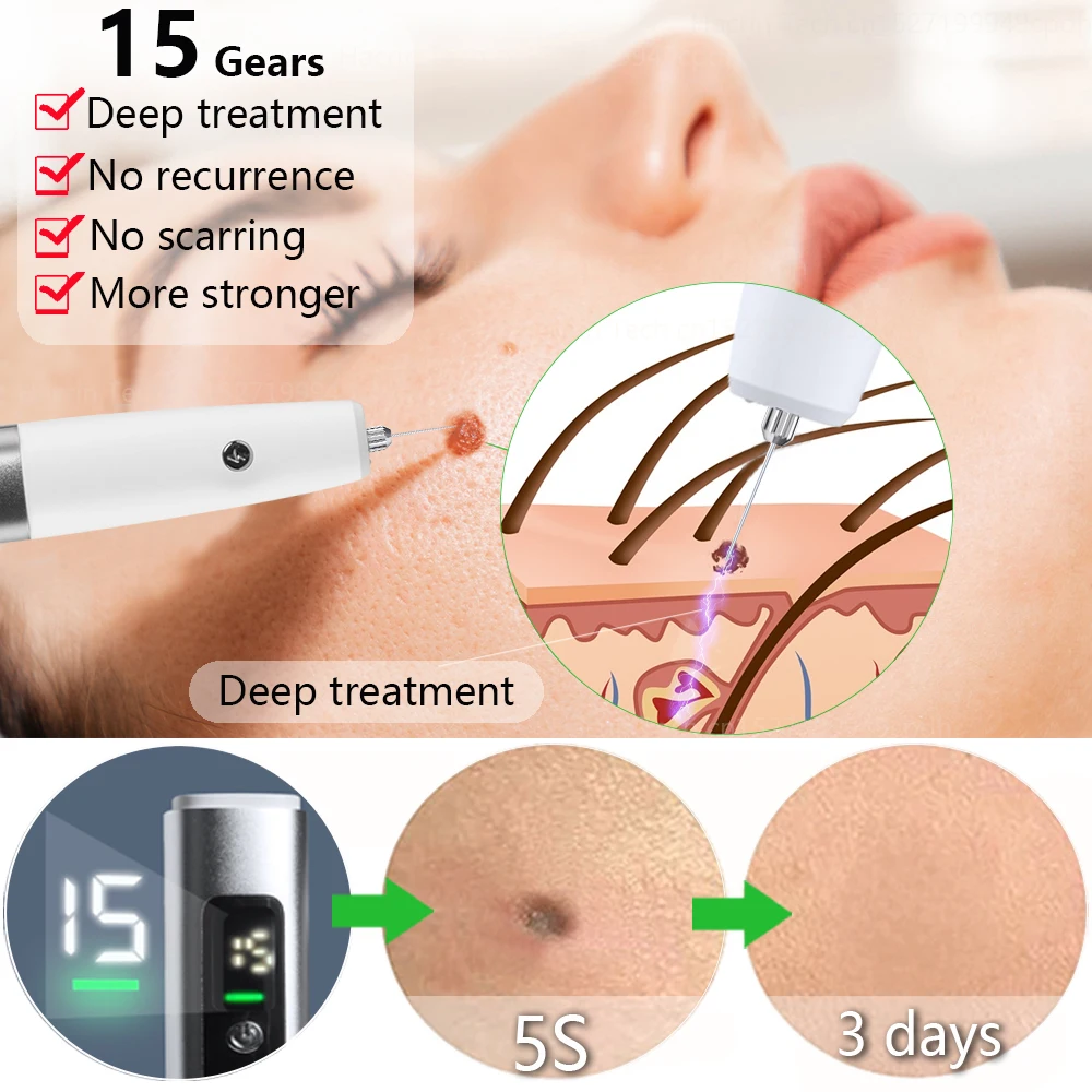 Laser Plasma Pen Electric Skin Tag Removal Black Dots Laser Plasma Pen Wart Spot Freckle Dark Dot Nevus Flat Tattoo Mole Remover