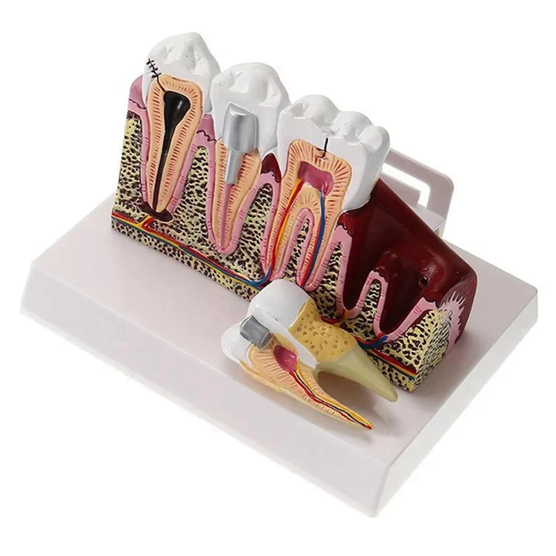 

ABNO-Standard Oral Teeth Anatomical Teaching Model Comprehensive Tooth Structure Model Dentist Demonstration