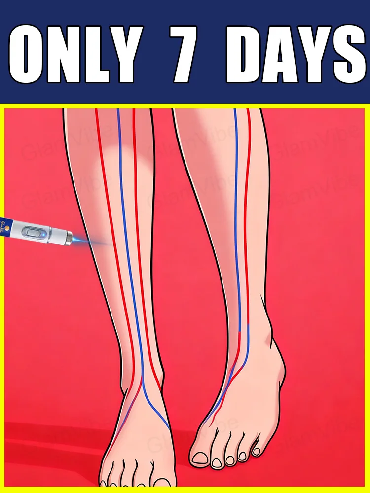 Bolígrafo de luz azul para resolver venas varicosas, gran oferta de herramientas para el cuidado de las piernas