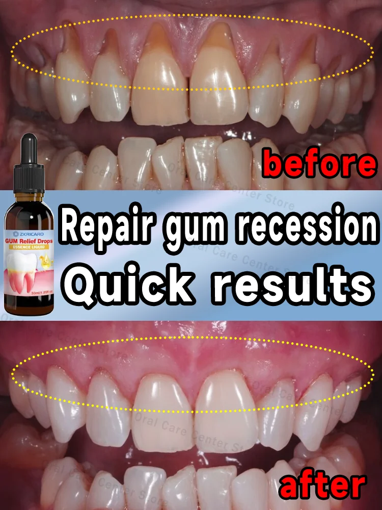 Repair damaged gums, effectively eliminate gum bleeding, and quickly relieve toothache