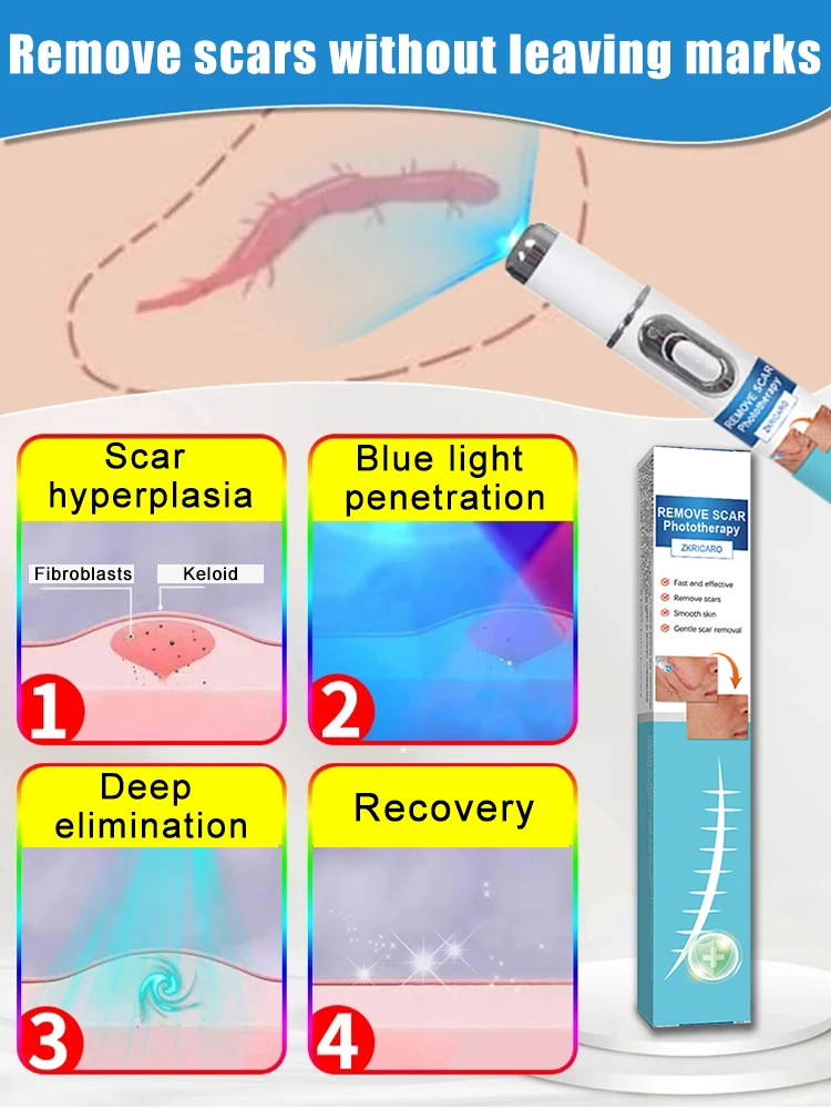 Magisch hellt Narben auf. Der professionelle Narbenlaserstift hilft Ihnen, dass die perfekte Haut immer noch sicher und effizient und schmerzlos ist
