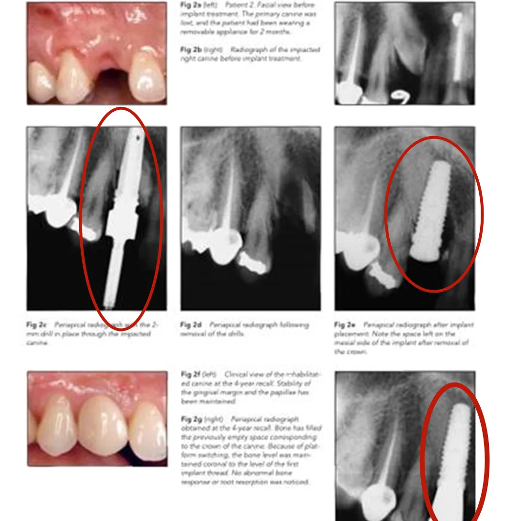 3 rozmiary rękojeści dentystycznej Wiertła do ekspansji kości Wiertła śrubowe do ekspanderów kompresyjnych