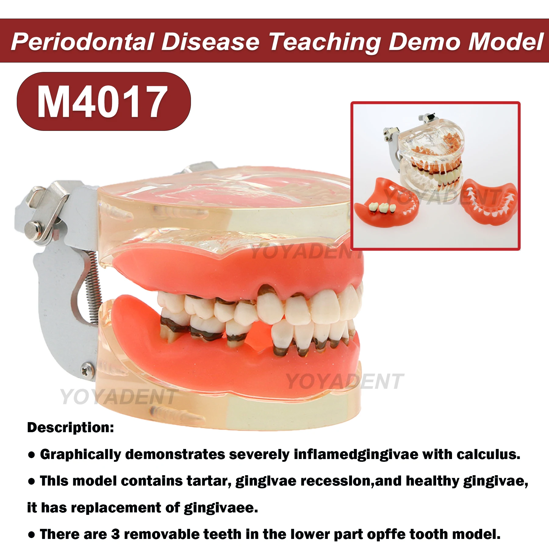 Dental Resins Model Periodontal Disease Pathological Teaching Model For Patient Education Demo Accessories M4017