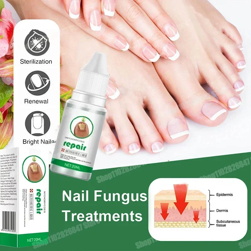 

Strong Nail Fungus Treatment Serum Essence oil Feet Nails Repair Care Essence Cream Anti Infection Toe Fungal Removal