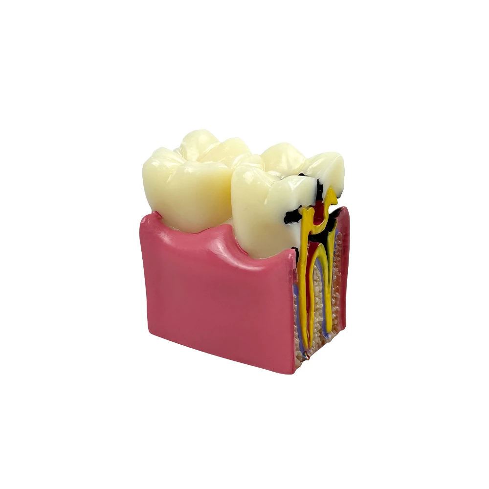 6 Times Dental Caries Teeth Model Pathological Molar Cross Section Model Tooth Decay Comparsion Study Demonstration Model