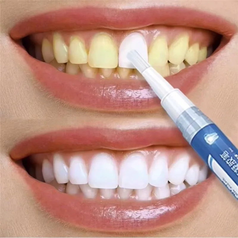 

1Pc Teeth Whitening Gel Pen Oral Care Remove Stains Tooth Cleaning Tool Tooth Whitening Products